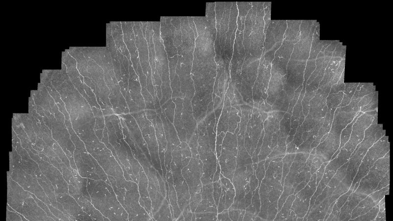 New Imaging Technology Makes Corneal Nerves Visible Over a Large Area