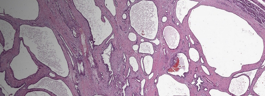 Microscopy of the tissue structure of a serous cystadenoma in the pancreas