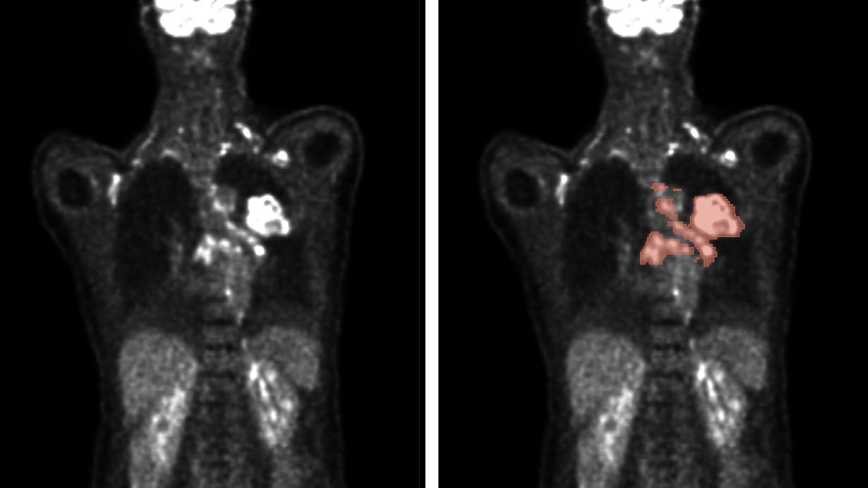 Automatische Verfahren ermöglichen die Analyse von PET/CT-Scans (links) zur präzisen Vorhersage von Tumorlage und -größe (rechts) für eine verbesserte Diagnose und Therapieplanung